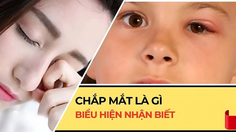 Chắp mắt là gì và dấu hiệu để nhận biết chắp mắt 