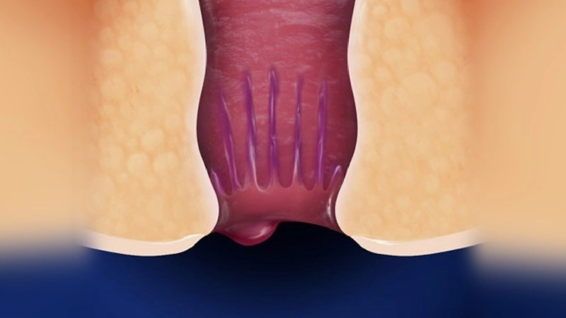 Mẹo và biện pháp chữa trị khi bị chảy máu hậu môn