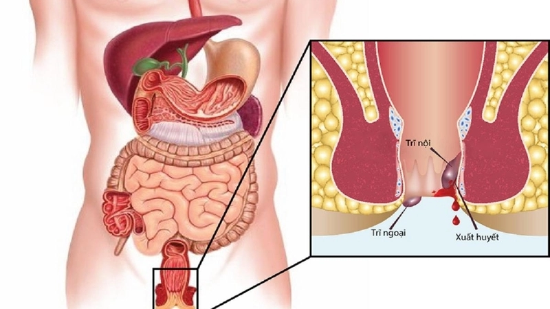 Triệu chứng khi bị chảy máu hậu môn