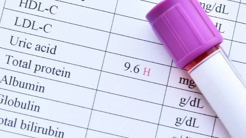 Cách kiểm tra chỉ số acid uric chính xác