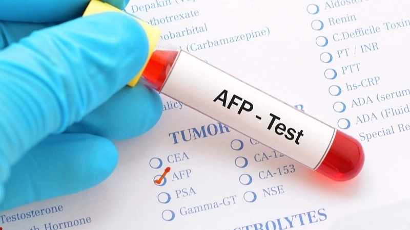 Khi nào nên thực hiện xét nghiệm AFP?