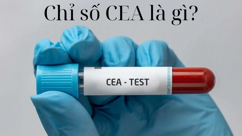 Chỉ số CEA là gì?