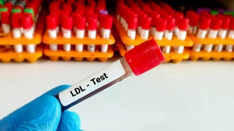 Chỉ số LDL-C bao nhiêu là bình thường?