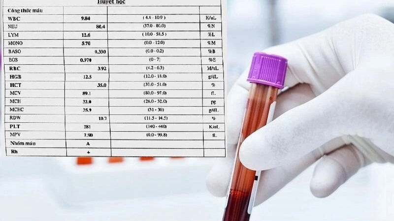 MPV có ý nghĩa gì trong chẩn đoán sức khỏe?