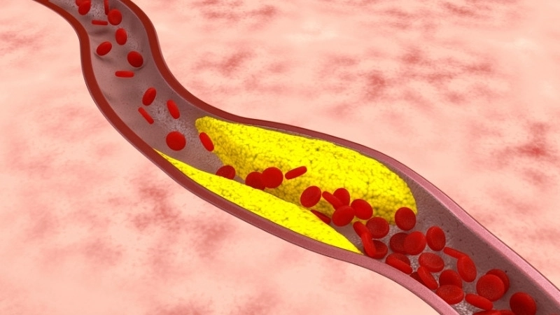 Nguyên nhân khiến chỉ số Triglyceride tăng cao