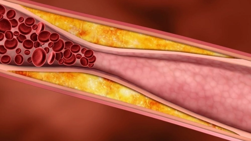 Chỉ số Triglyceride cao gây ra biến chứng gì?