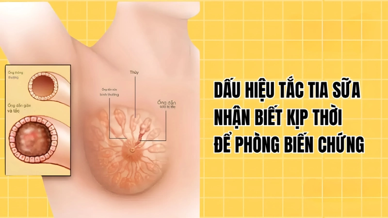 Dấu hiệu nhận biết mẹ đang bị tắc tia sữa