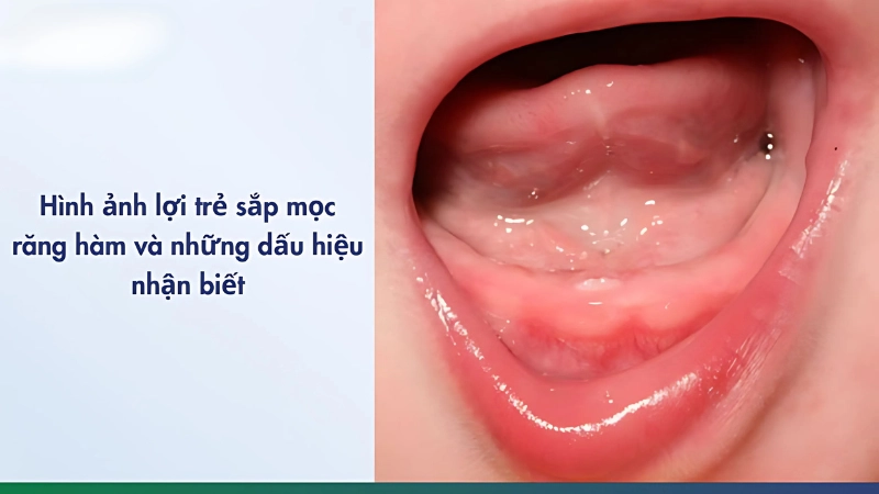 Dấu hiệu trẻ sắp mọc răng cha mẹ cần nhận biết