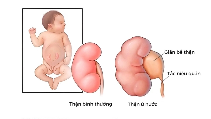 Em bé bị giãn thận có sao không?