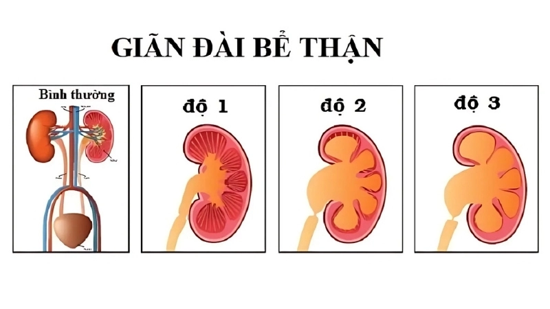 Triệu chứng khi bị giãn thận ở trẻ nhỏ