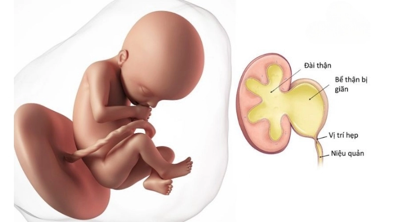Mẹo và biện pháp chữa trị khi bị giãn thận