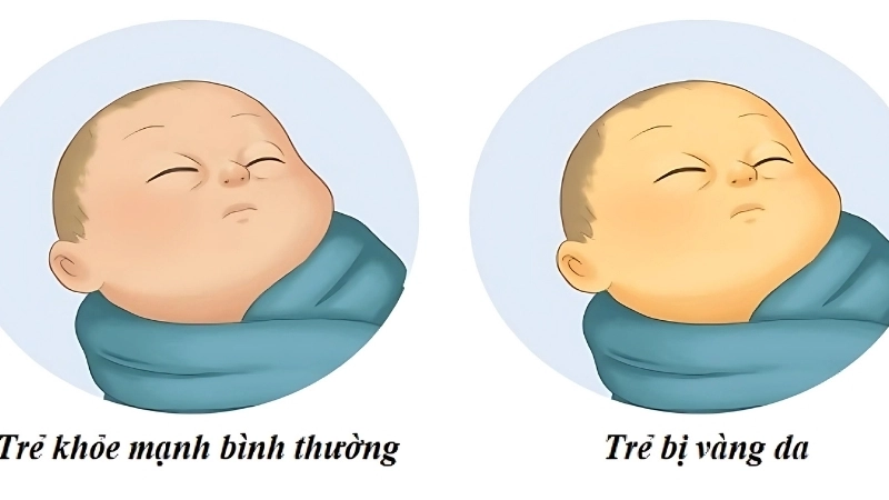 Em bé bị vàng da có sao không?