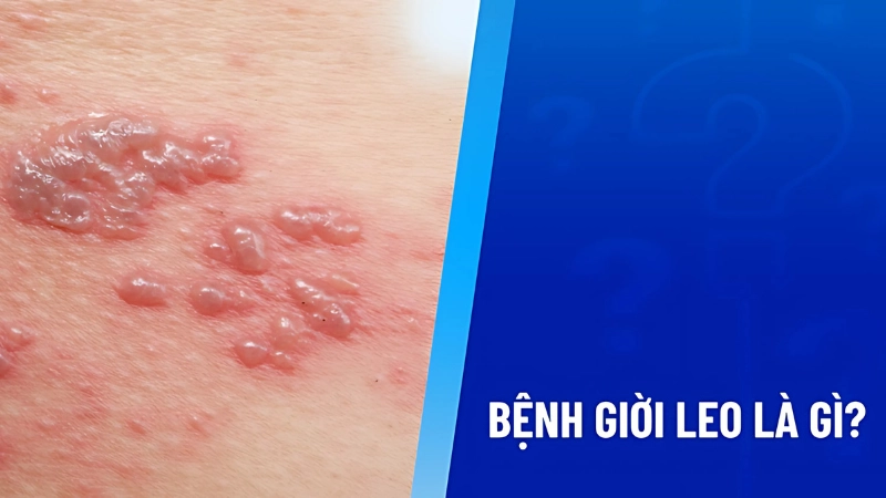 Giời leo là g và triệu hứng của bệnh giời leo 