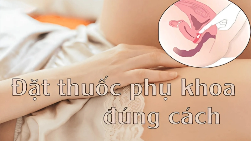 Hướng dẫn cách đặt thuốc phụ khoa đúng cách