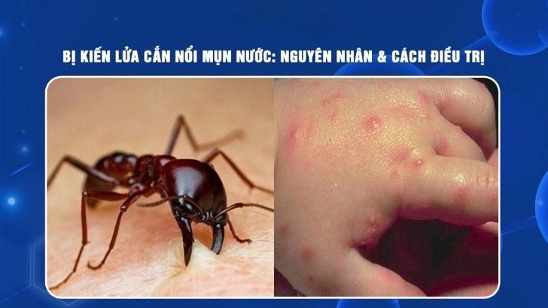 Kiến lửa cắn có bị sao không?