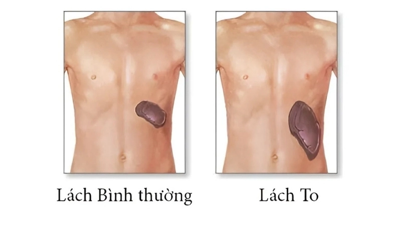 Lá lách to có bị sao không?