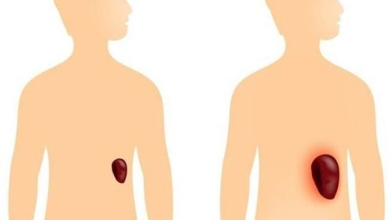 Dấu hiệu nhận biết khi bị lá lách to