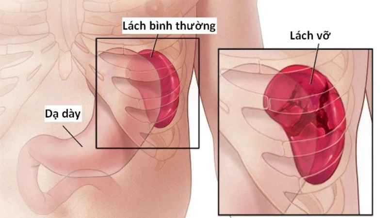 Phương pháp và mẹo chữa trị khi bị lá lách to