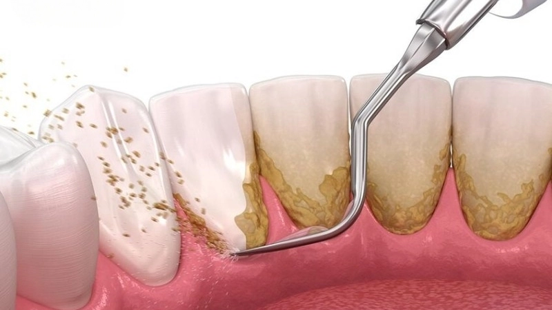 Lấy cao răng có bị sao không?