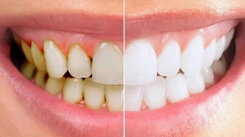 Dấu hiệu nhận biết khi bị ảnh hưởng sau khi lấy cao răng