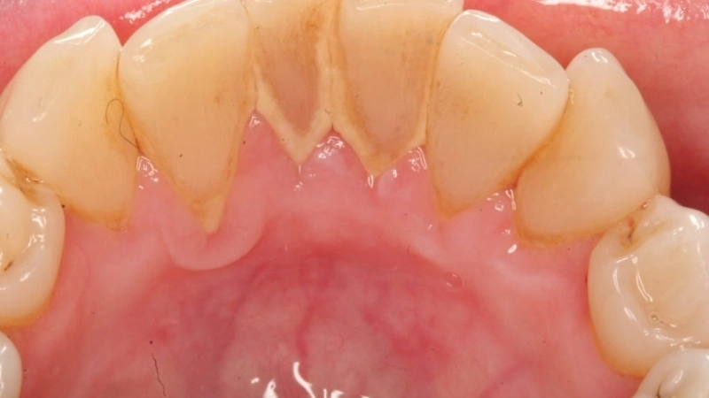 Phương pháp và mẹo chữa trị khi bị ê buốt sau lấy cao răng