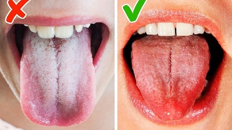 Triệu chứng khi bị lưỡi trắng