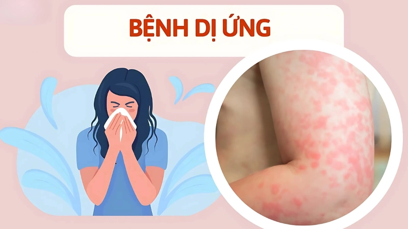 Lưu ý khi áp dụng mẹo chữa dị ứng ngứa