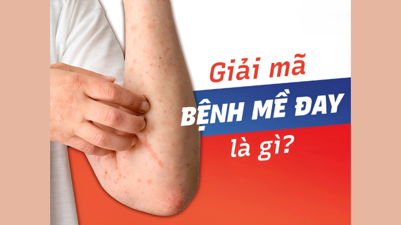 Mề đay là gì