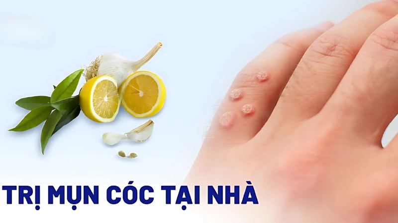 Mẹo chữa mụn cóc tại nhà an toàn hiệu quả