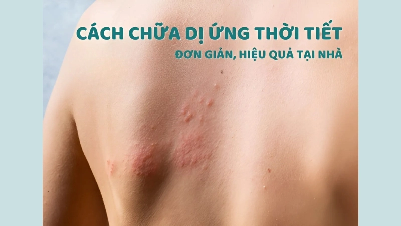 Mẹo dân gian chữa dị ứng ngứa dễ làm tại nhà