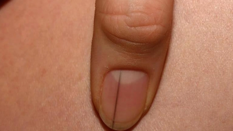 Cách khắc phục tình trạng móng tay bị sọc dọc