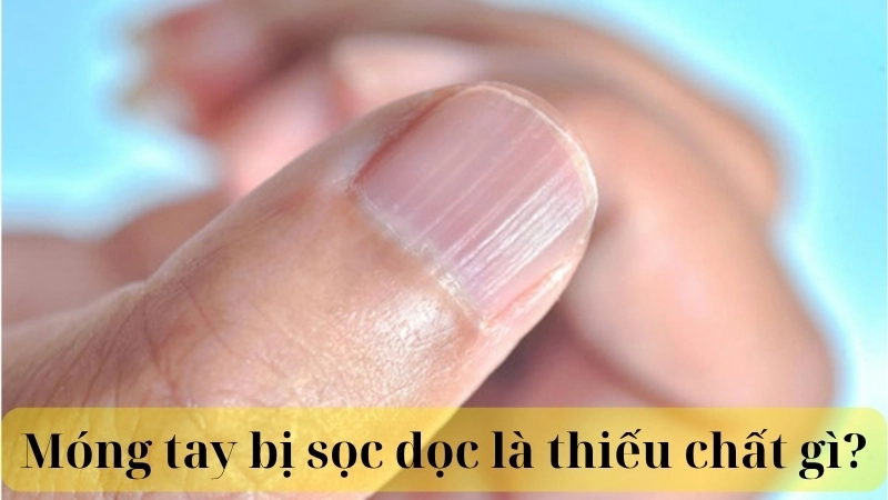 Móng tay bị sọc dọc là thiếu chất gì?