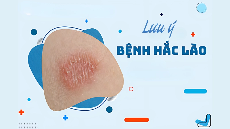 Một số lưu ý khi áp dụng mẹo dân gian trị hắc lào