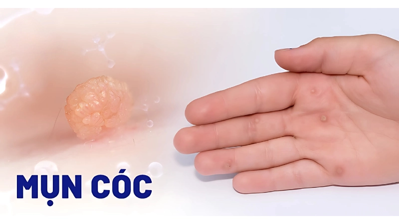 Mụn cóc là gì và vì sao xuất hiện