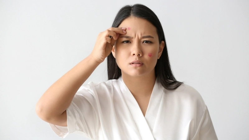 Mụn cóc - một dạng tổn thương da do virus