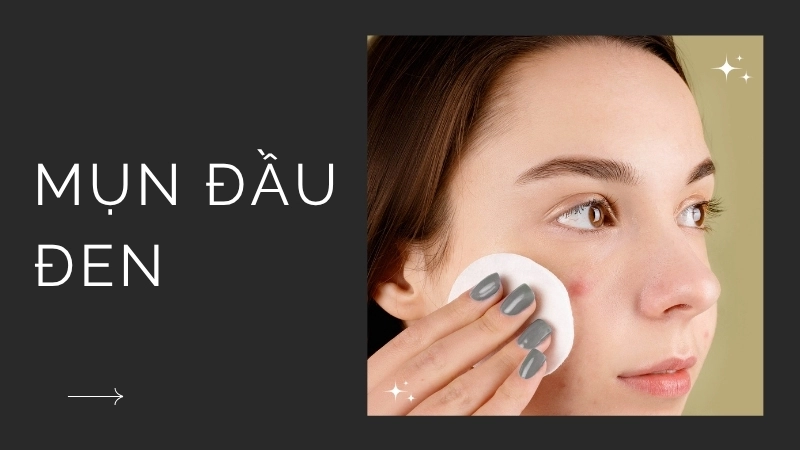 Mụn đầu đen và mụn đầu trắng – những vị khách không mời trên da
