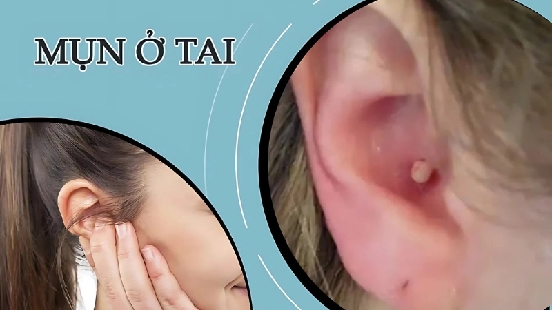 Mẹo và biện pháp chữa trị khi bị mụn mọc trong tai