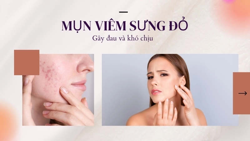 Mụn viêm sưng đỏ, gây đau và khó chịu
