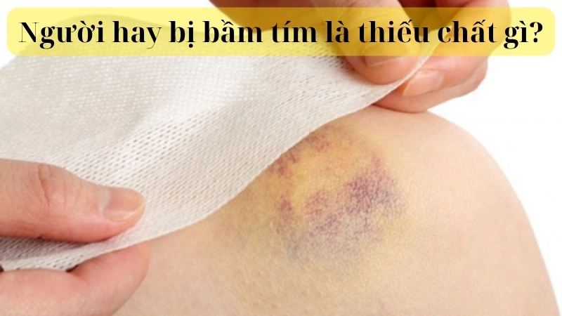 Người hay bị bầm tím là thiếu chất gì?