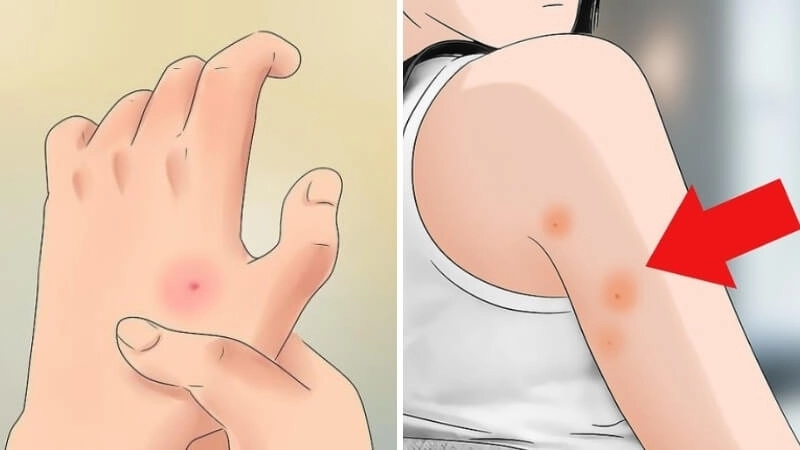 Dấu hiệu nhận biết khi bị nhện cắn