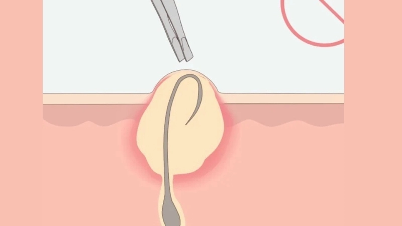 Triệu chứng khi bị viêm hay tổn thương do nhổ lông chân