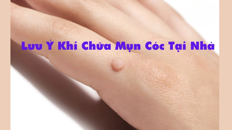Những lưu ý khi chữa mụn cóc tại nhà 