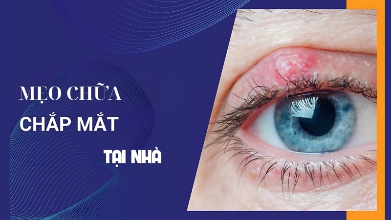 Những mẹo chữa chắp mắt tại nhà dễ áp dụng