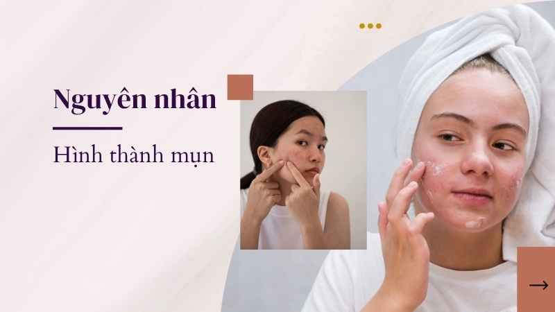 Những nguyên nhân kích thích sự hình thành của mụn