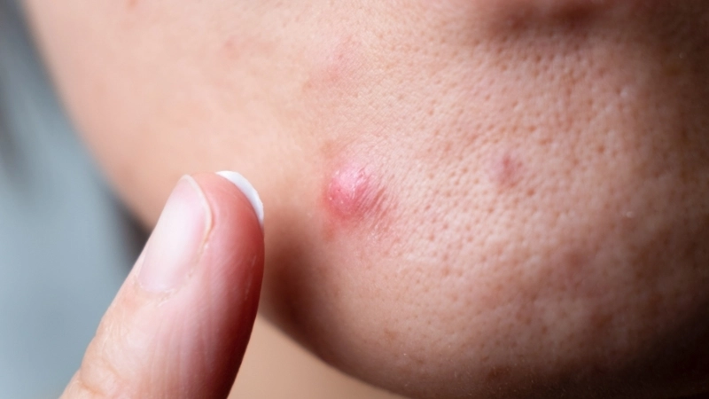 Nguyên nhân gây nổi mụn ở cằm là gì?