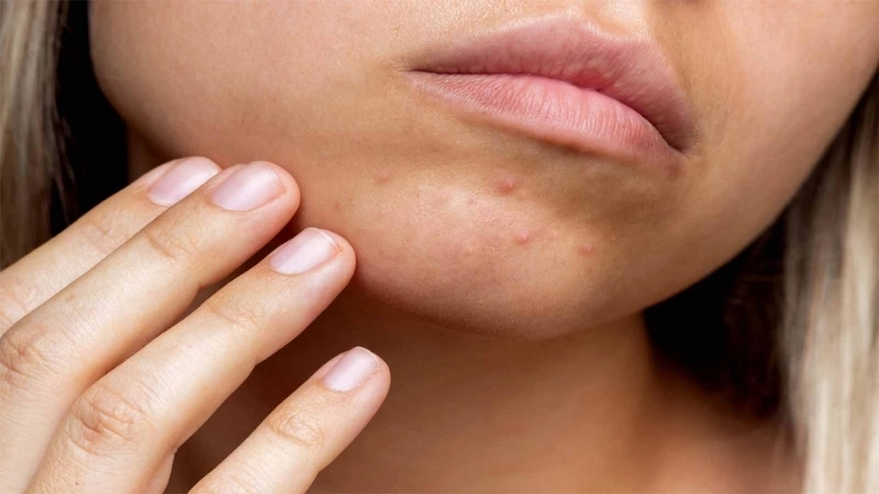 Những lưu ý quan trọng khi điều trị mụn ở cằm tại nhà