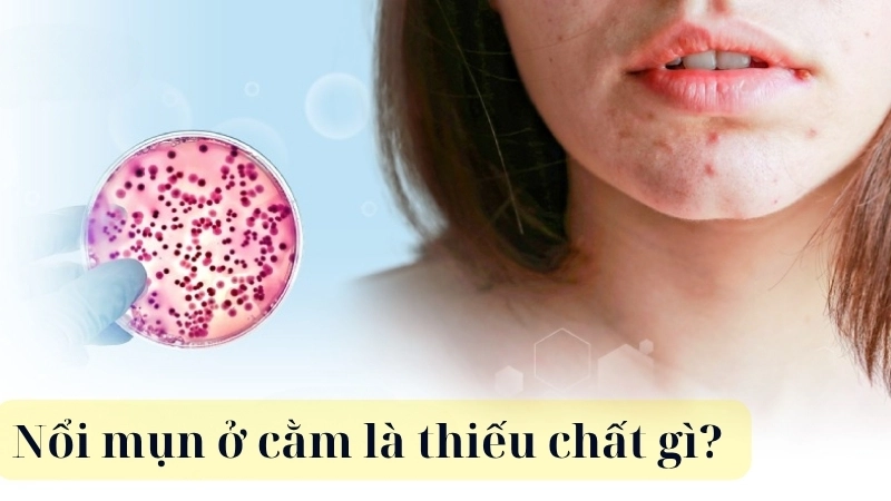 Nổi mụn ở cằm là thiếu chất gì?
