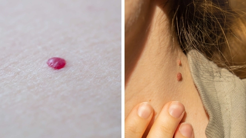 Nốt ruồi son – Dấu hiệu của sự phát triển mạch máu