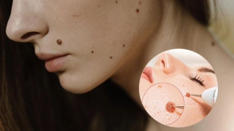 Nốt ruồi trên mặt – Điểm nhấn thú vị trên gương mặt
