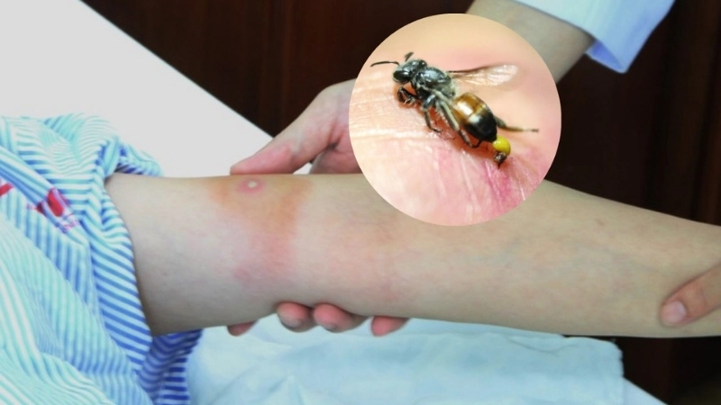 Dấu hiệu nhận biết khi bị ong đốt